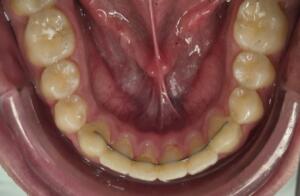 fil contention colle inférieur