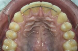 fil contention colle superieur