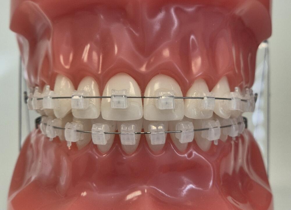 multiattache céramique autoligaturant