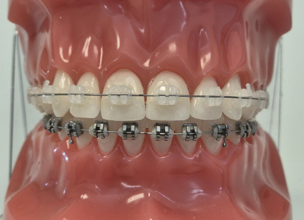 multiattache mixte ceramométallique