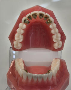 multiattache technique linguale